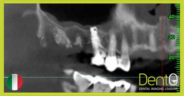 Οδοντική Κυψελίτιδα και Υπολείμματα Ρίζας